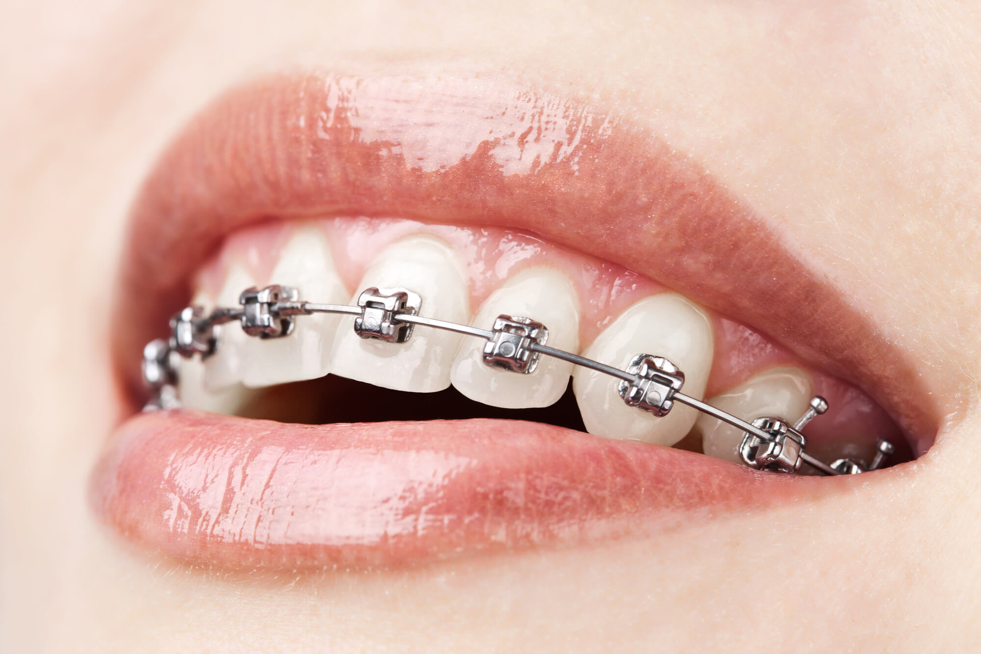 woman's braces in 33304