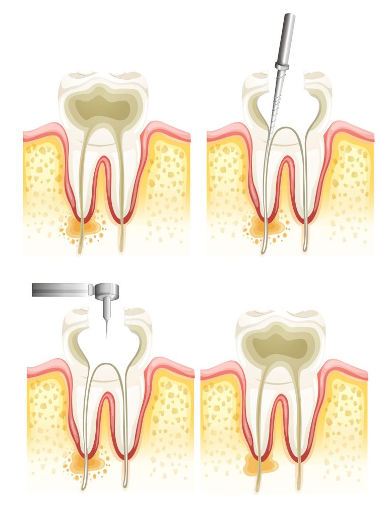 Where can I get a Root Canal Fort Lauderdale?