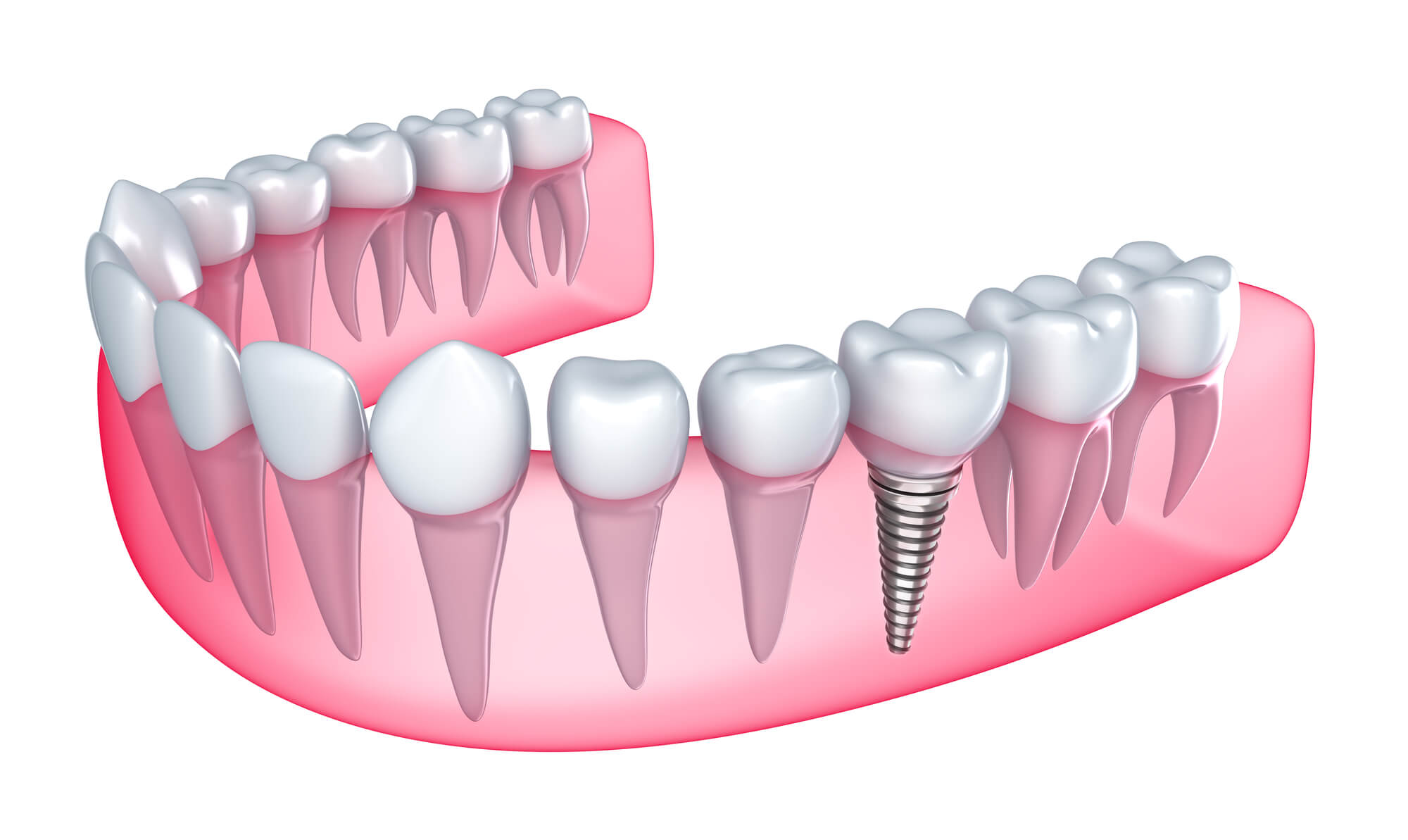 dental implants fort lauderdale