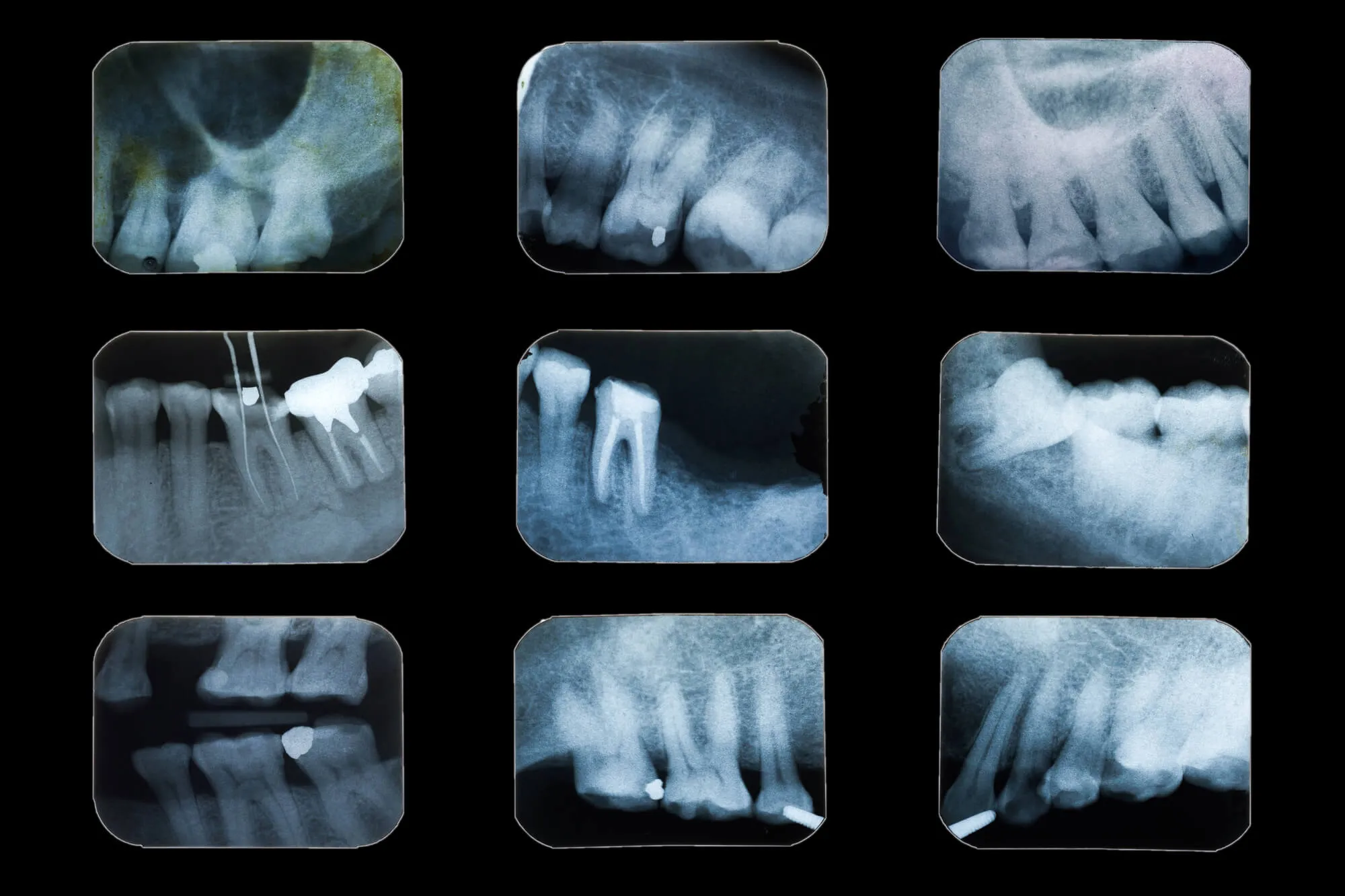 xray images obtained by a dentist victoria park