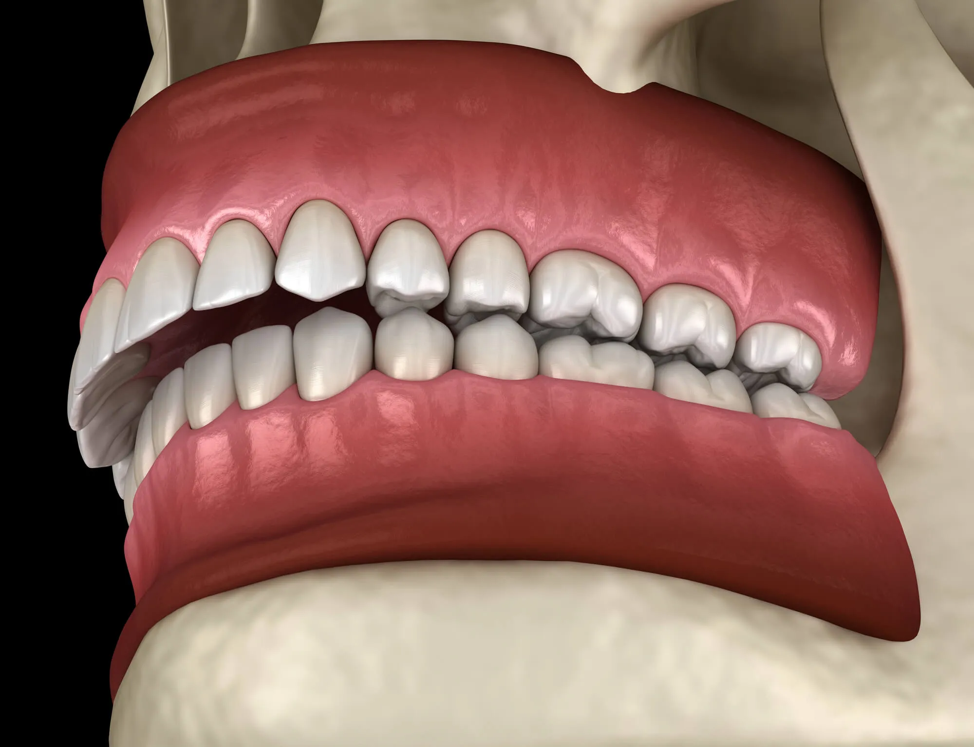 Dentists who take Medicare in Fort Lauderdale overbite
