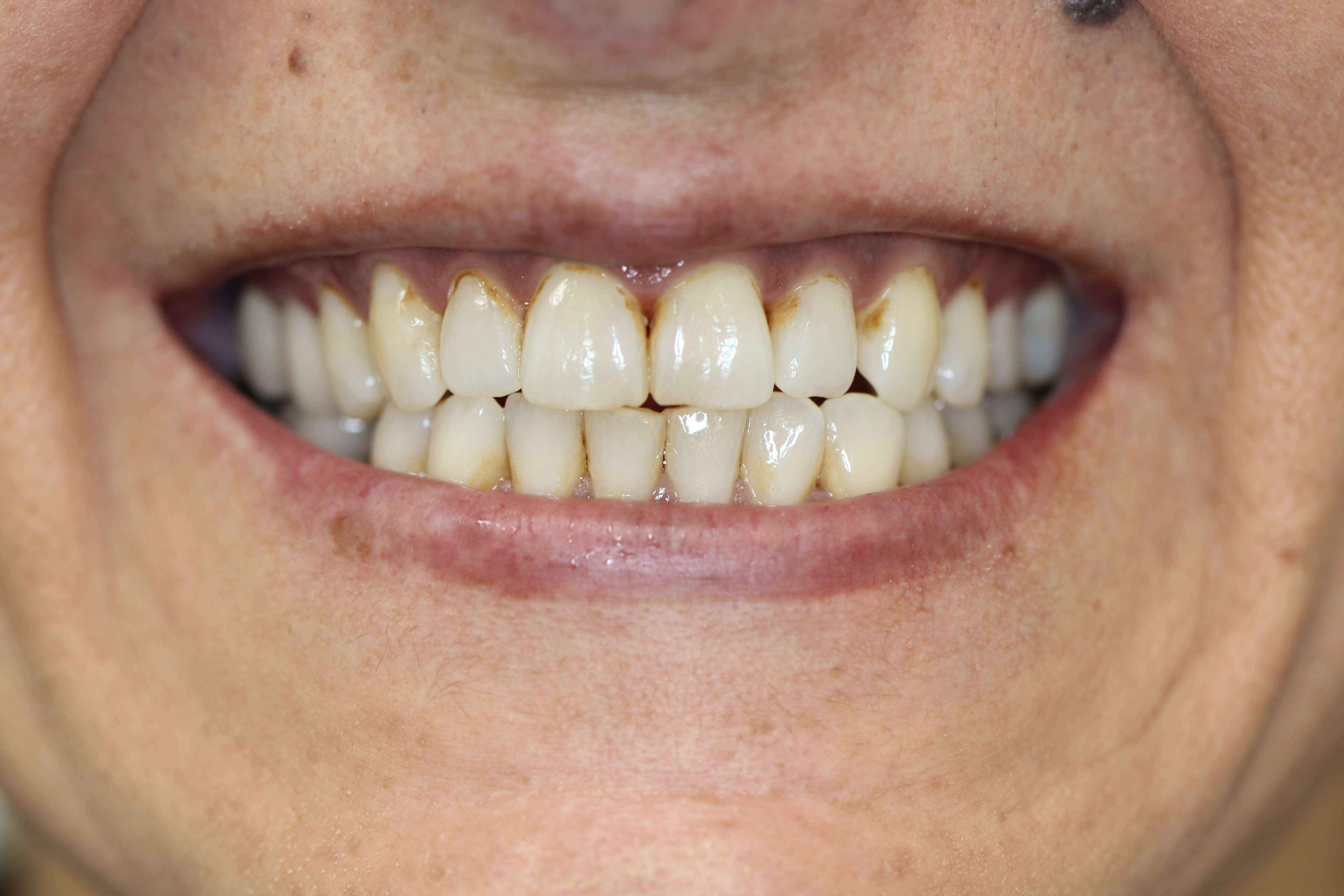 before and after treatment