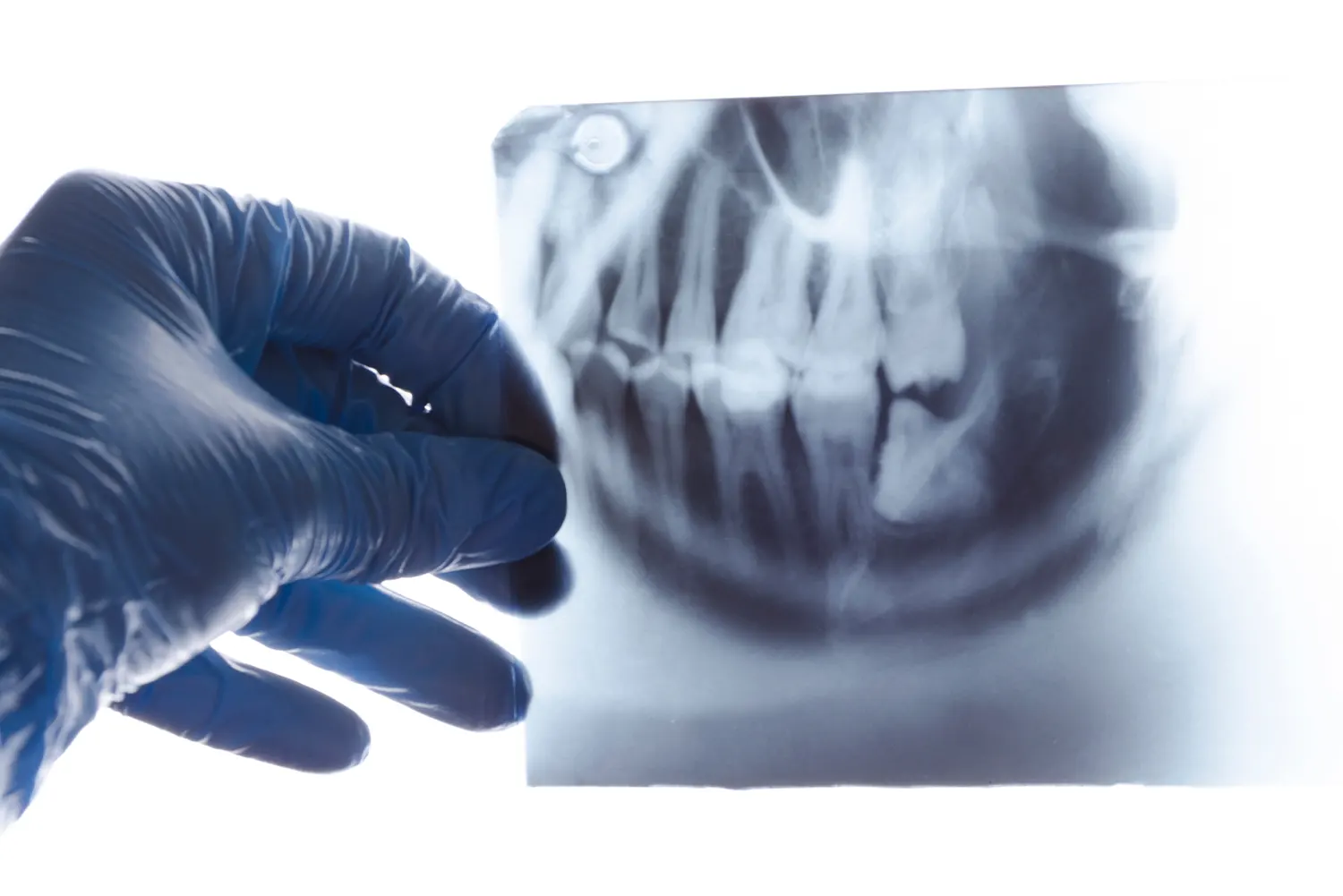 The Wisdom Teeth Extraction Process at New Horizon Dental Center: What to Expect
