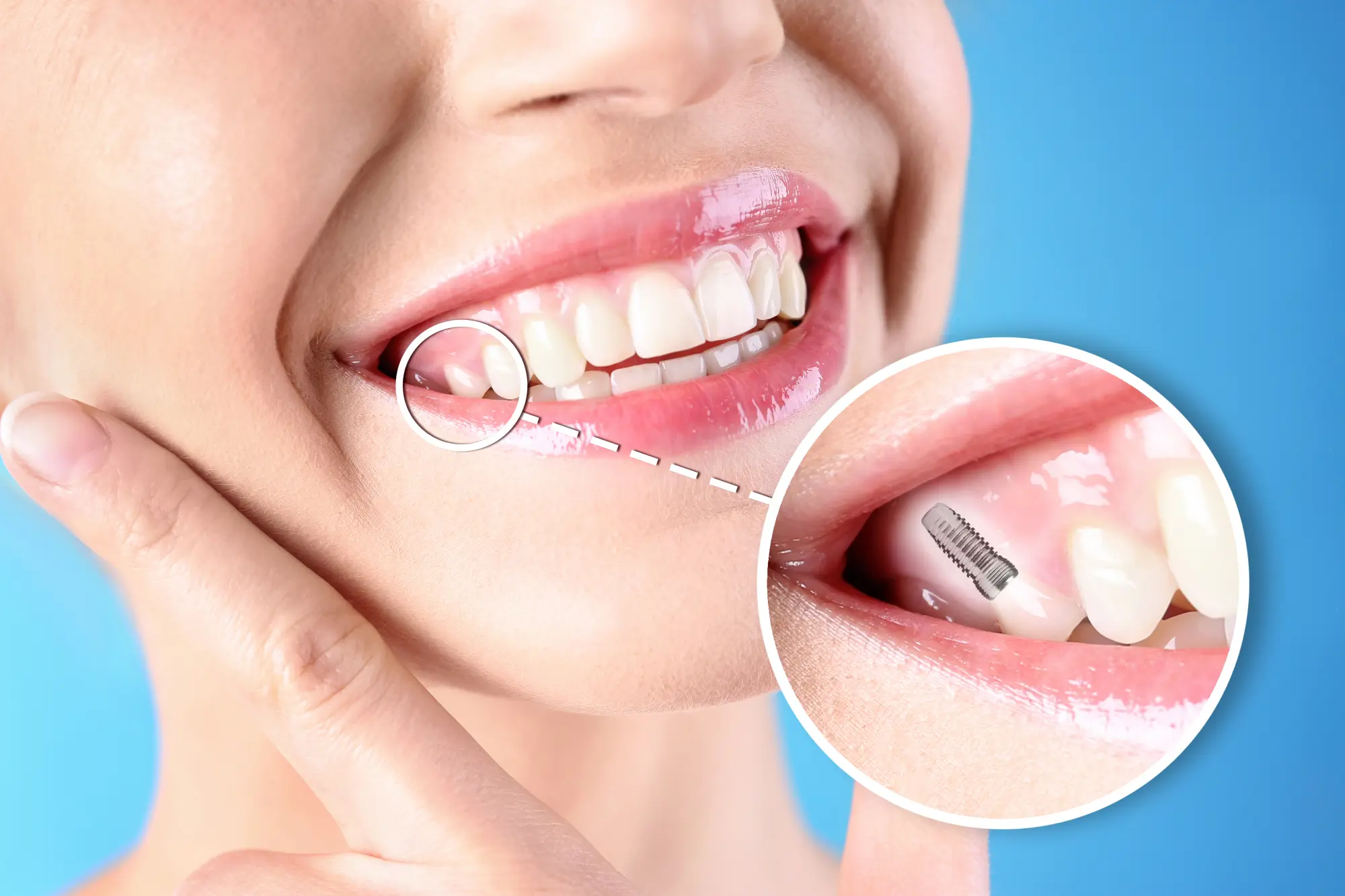 Bone Loss Prevention: Why Immediate Implant Placement is Crucial After Extraction