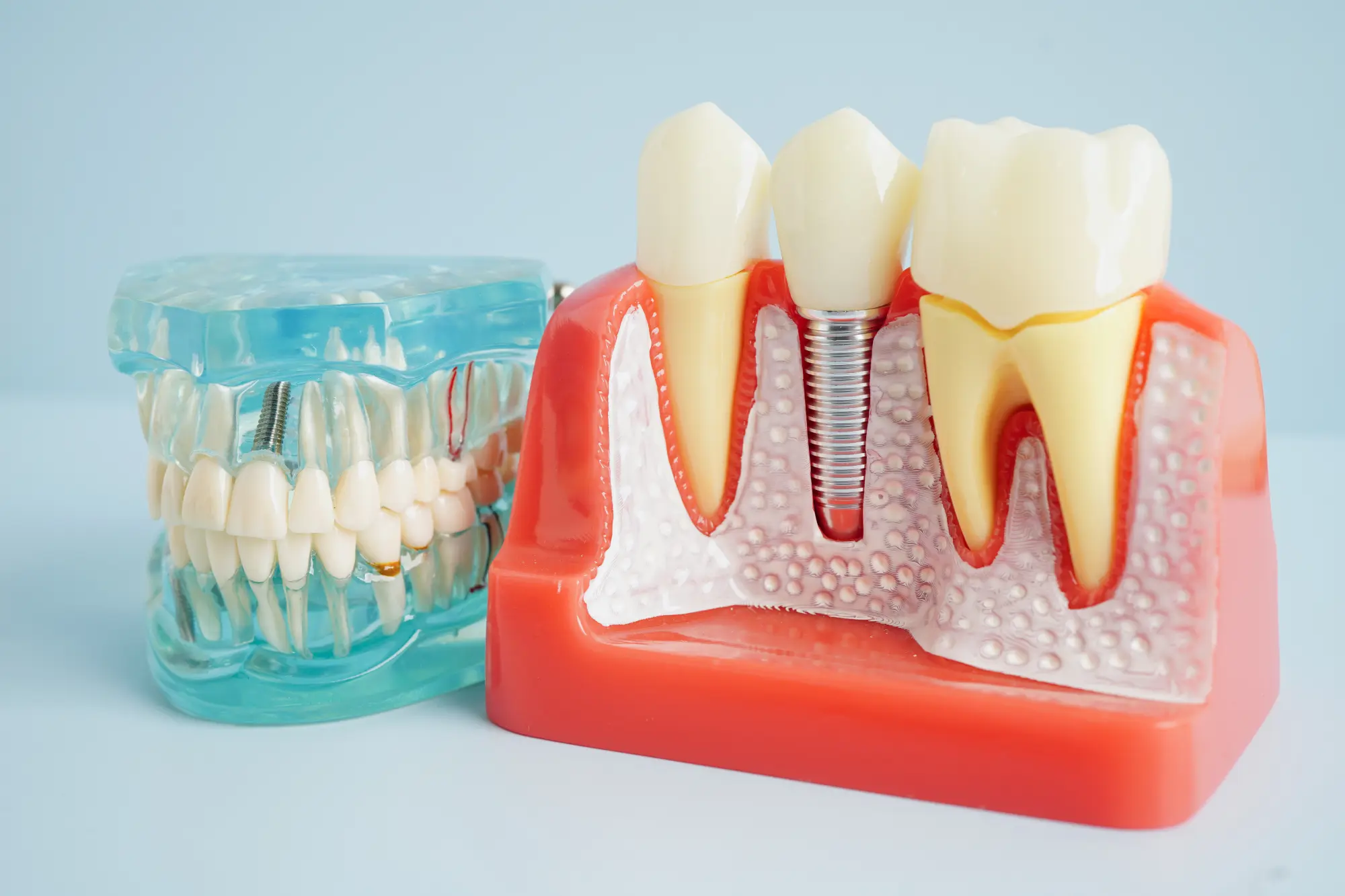 Dental Implants in Mesa, AZ: What to Expect at Your First Consultation