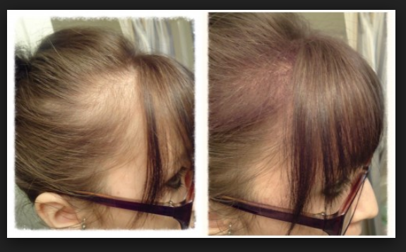 Cách làm mọc tóc ở trán