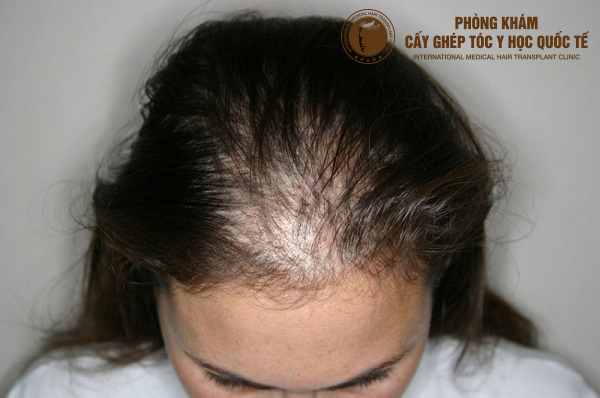 Cách làm mọc tóc ở trán