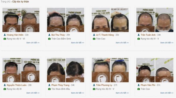 Cách làm mọc tóc ở trán