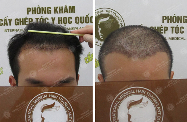 Cấy tóc có nguy hiểm không