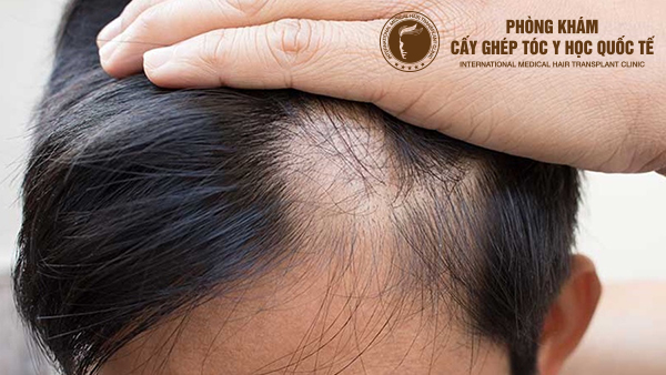 Tóc mỏng do di truyền