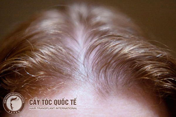 Tóc mỏng do di truyền