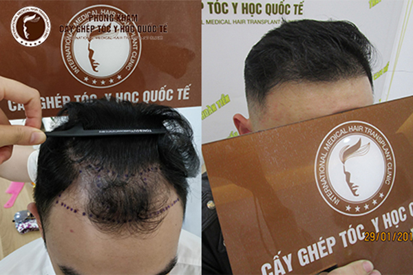 Cách chống rụng tóc