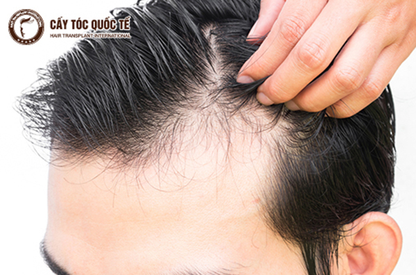 Điều trị rụng tóc phần trán