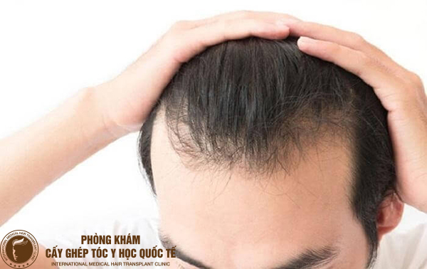 Điều trị rụng tóc phần trán