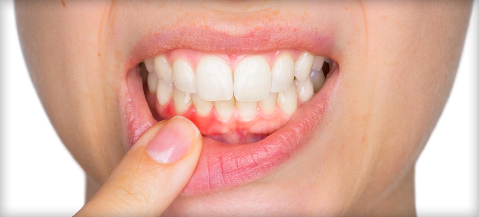 Gum Disease Warning Signs Most People Miss