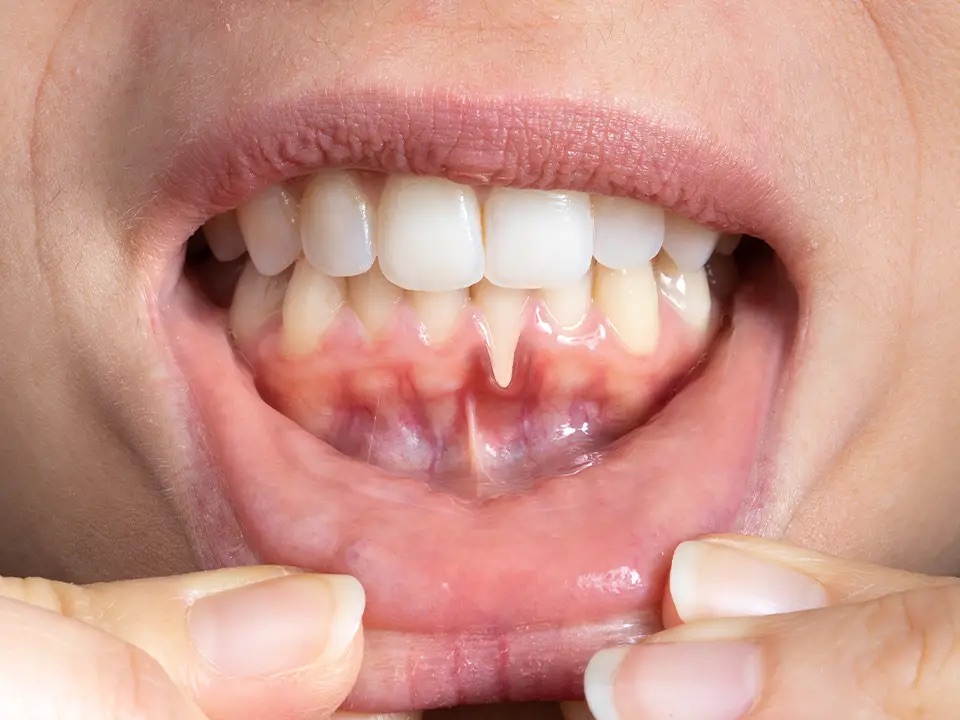 The Importance of Gum Health for Patients