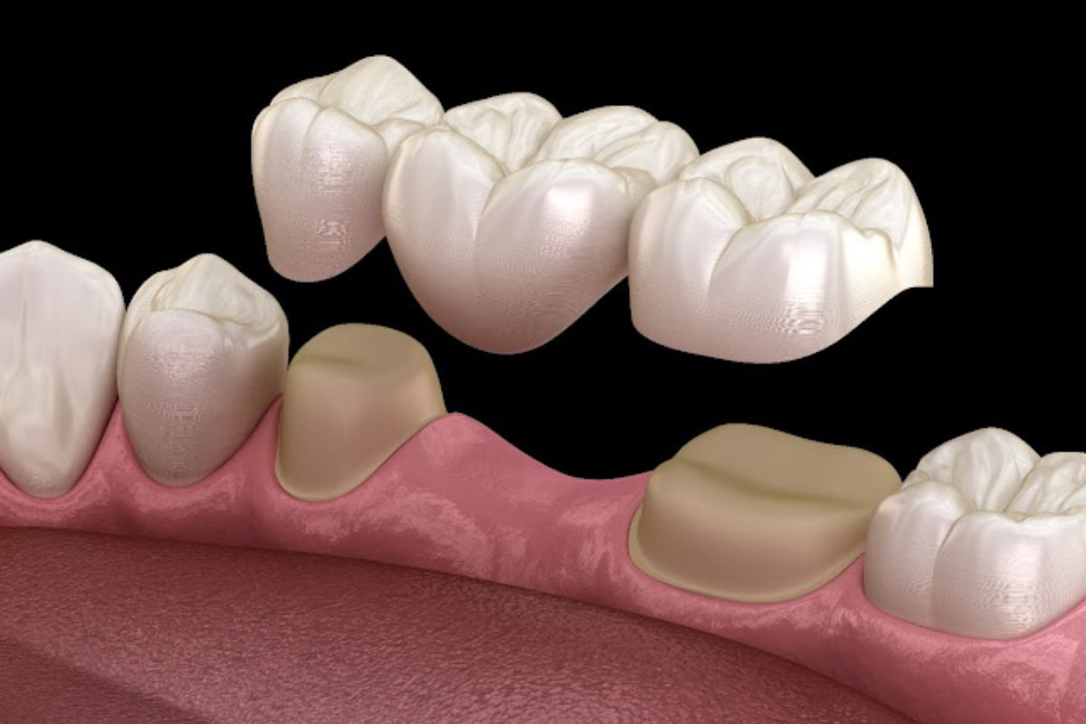 What to Know About Dental Bridges