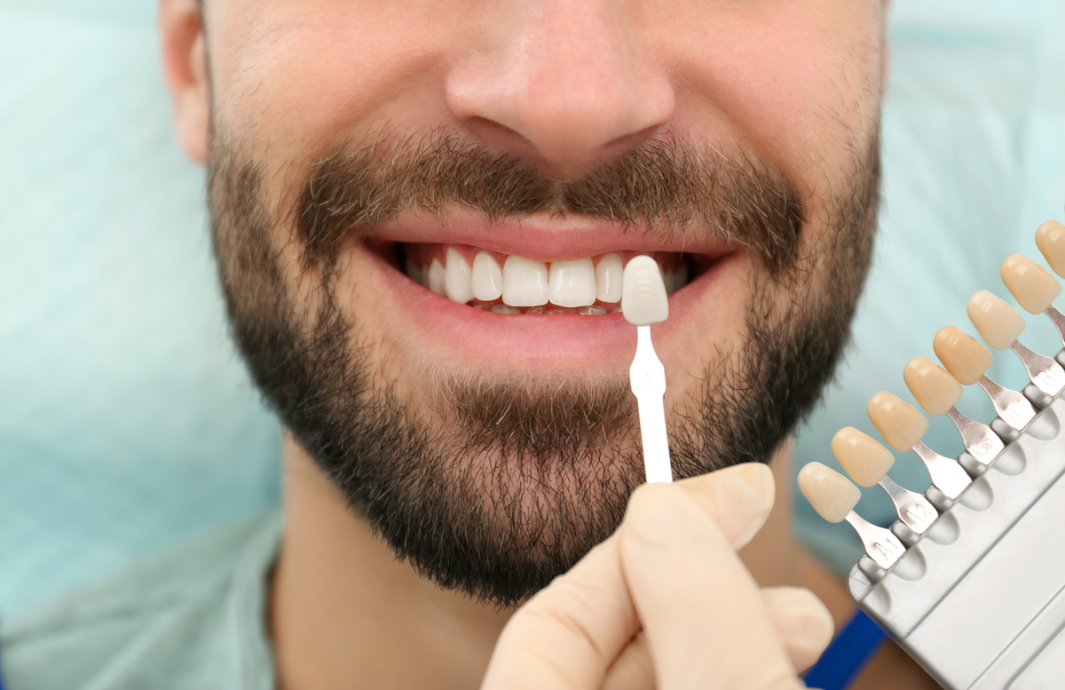 3 Signs It Might Be Time to Replace Your Veneers