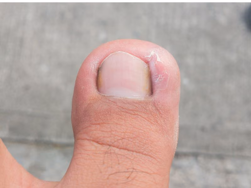 ingrown toenail