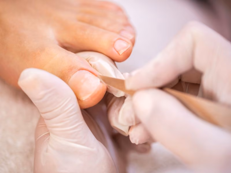 Nail Surgery Explained, Procedure and FAQs