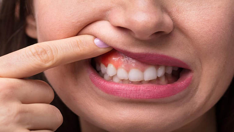cách chữa viêm lợi tại nhà