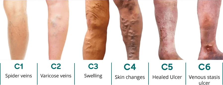 Different stages of vein disease