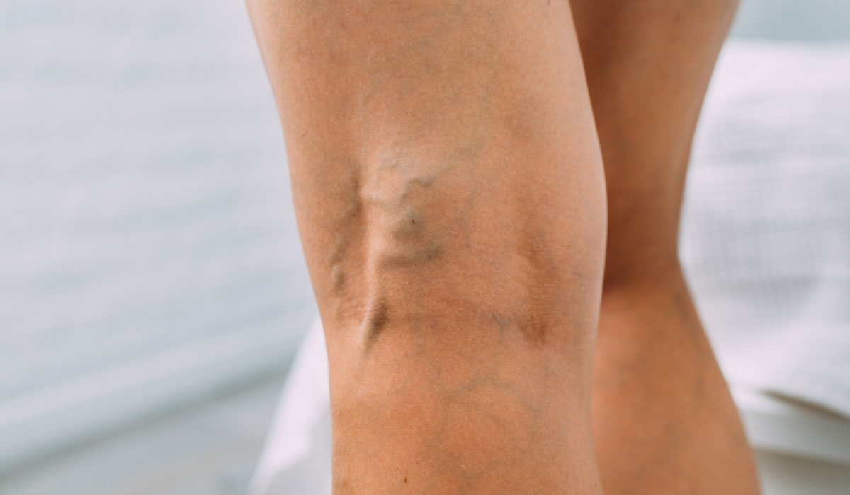 What to do if a varicose vein bursts