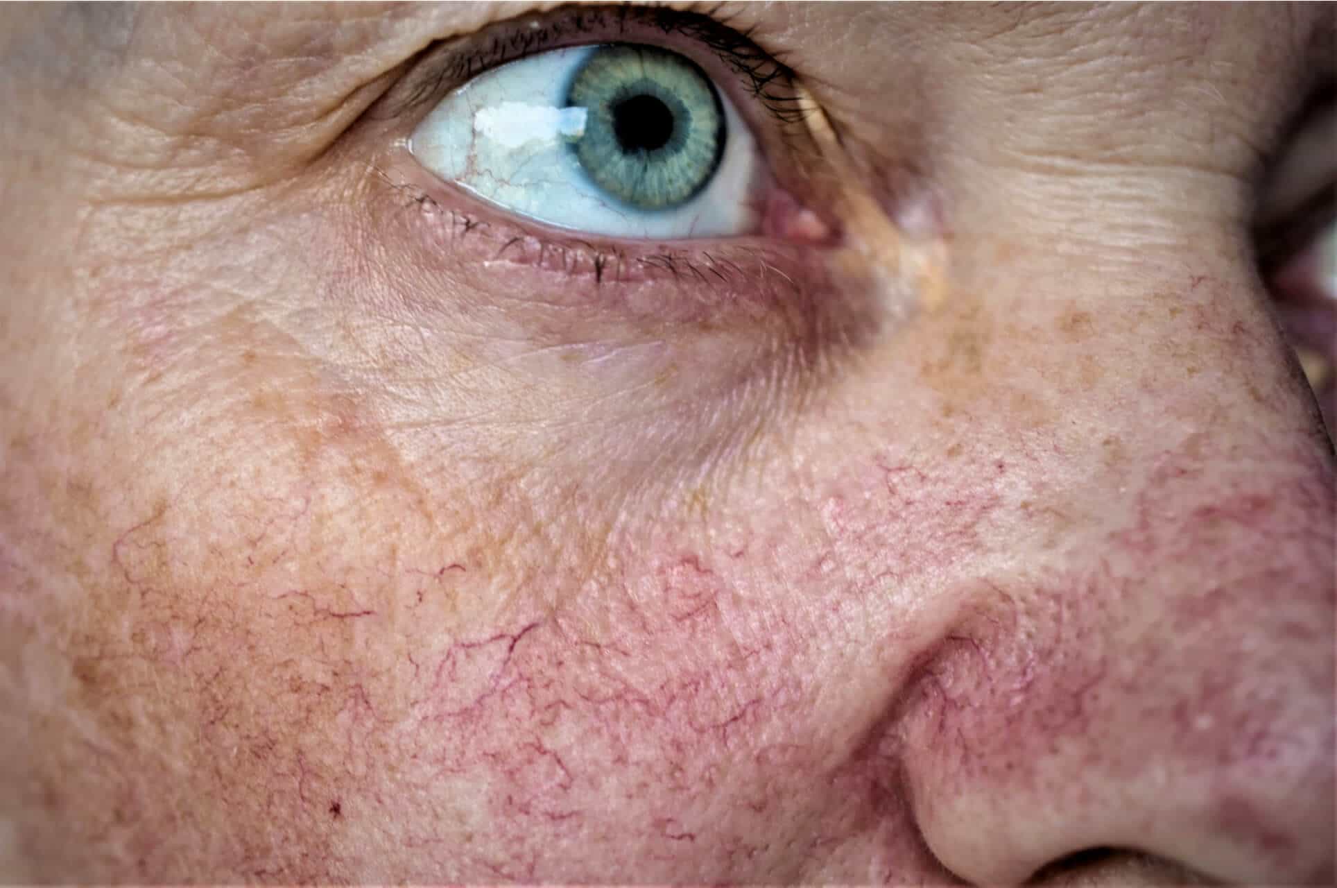 Veinwave Treatment For Thread Veins: Non-Invasive & Virtually Painless