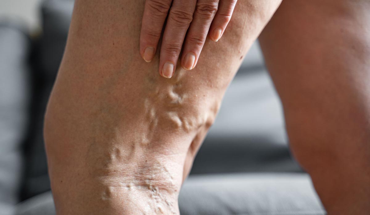 When should you worry about varicose veins?