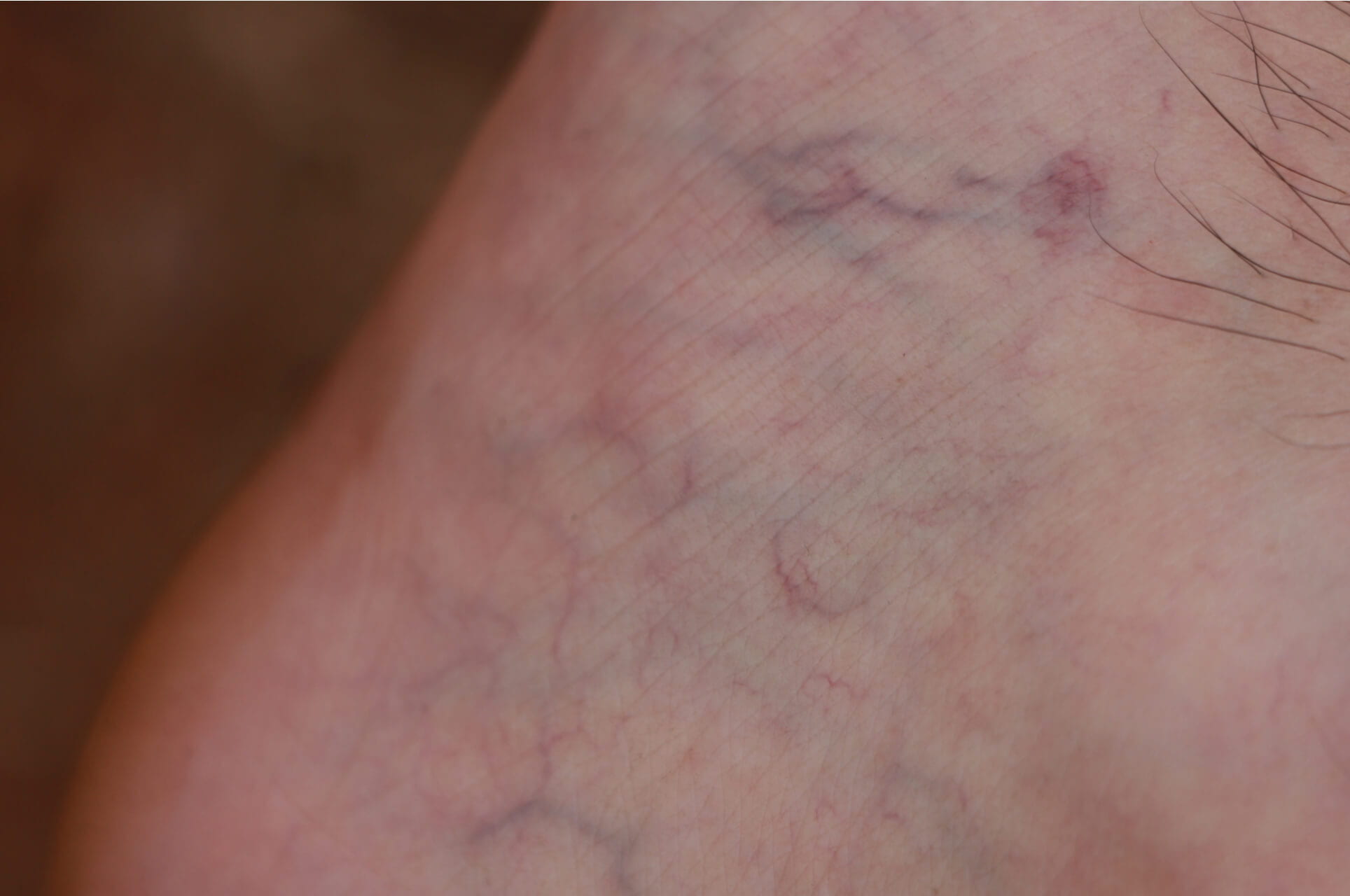 How To Prevent Spider Veins