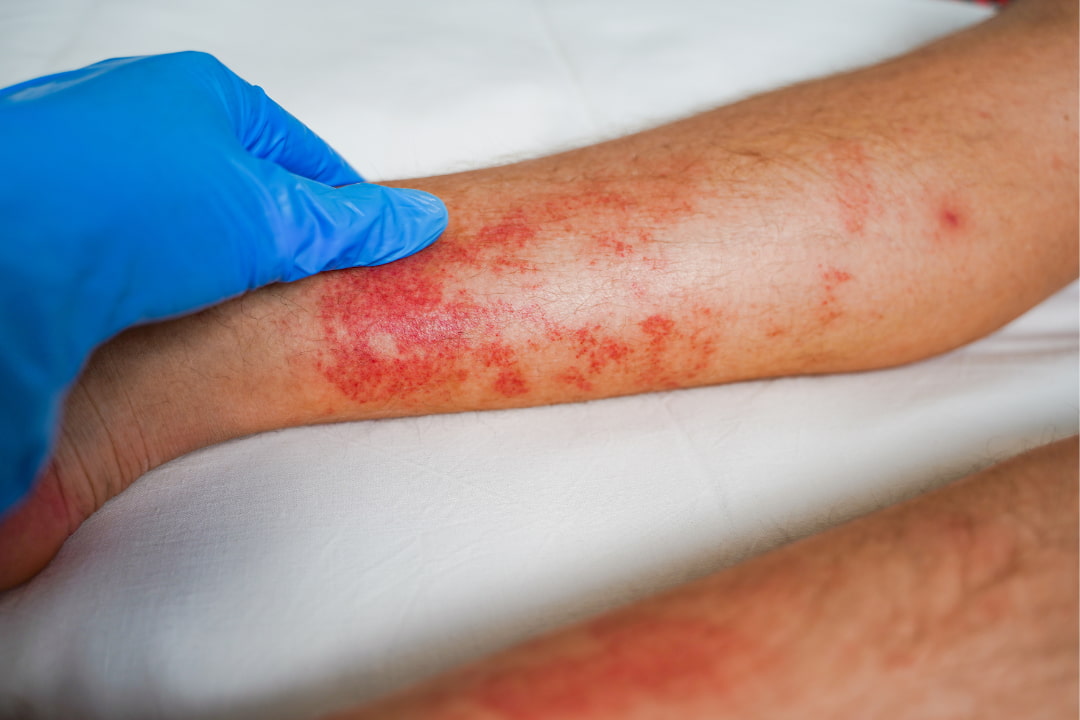 What is Varicose Eczema and How Can You Treat it?
