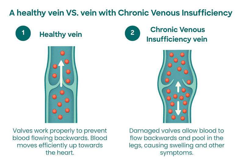 Chronic venous insufficiency illustration