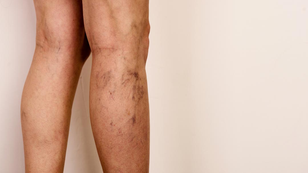 UKVeinClinic - Woman with varicose veins