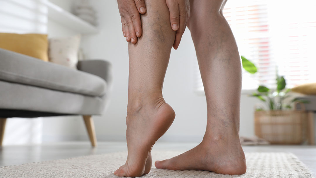 UK Vein Clinic - Woman with leg pain