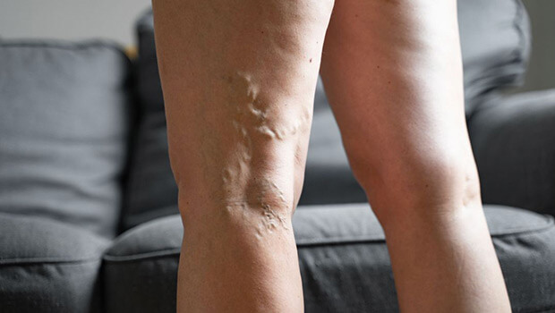 UK Vein Clinic - Varicose veins on the legs