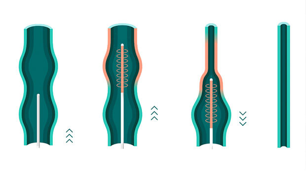 UK Vein Clinic - Endovenous radiofrequency ablation