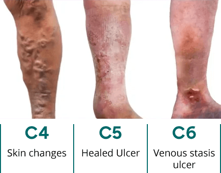 UK Vein Clinic – CEAP score: 4 to 6