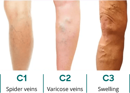 UK Vein Clinic – CEAP score: 1 to 3
