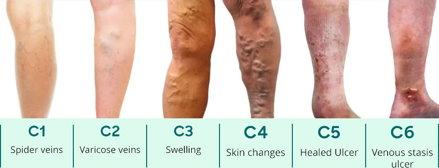 UK Vein Clinic - CEAP score