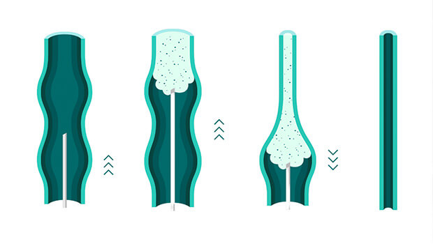 UK Vein Clinic – Foam sclerotherapy