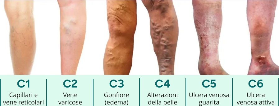 UK Vein Clinic – CEAP score