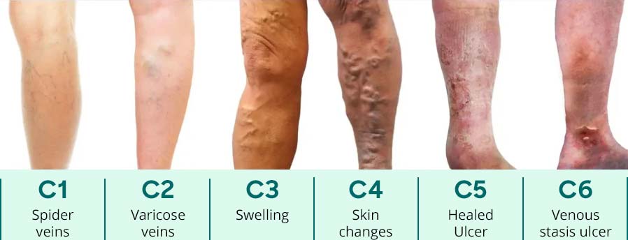UK Vein Clinic – CEAP score