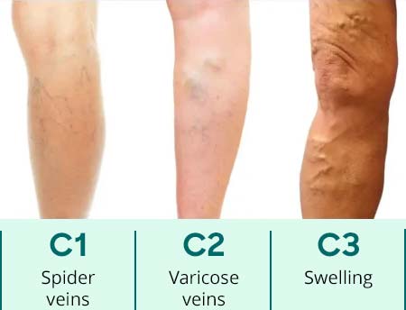 UK Vein Clinic – CEAP score: C1, C2, C3
