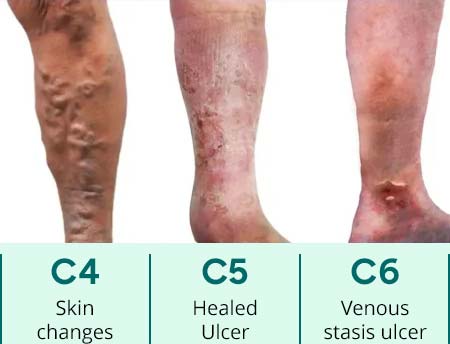 UK Vein Clinic – CEAP score: C4, C5, C6