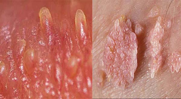 đốt sùi mào gà