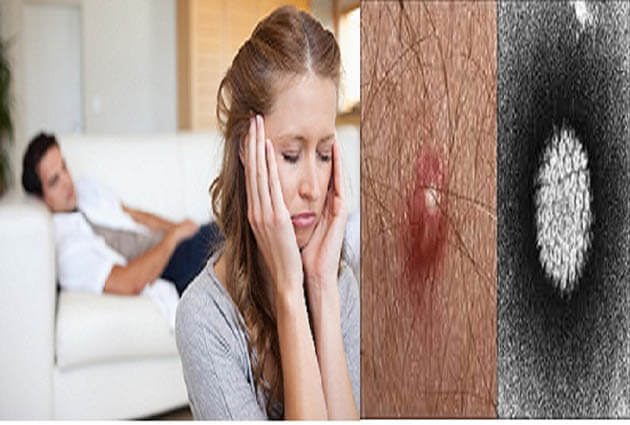 điều trị mọc mụn thịt ở vùng kín