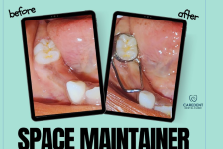 Space Maintainer