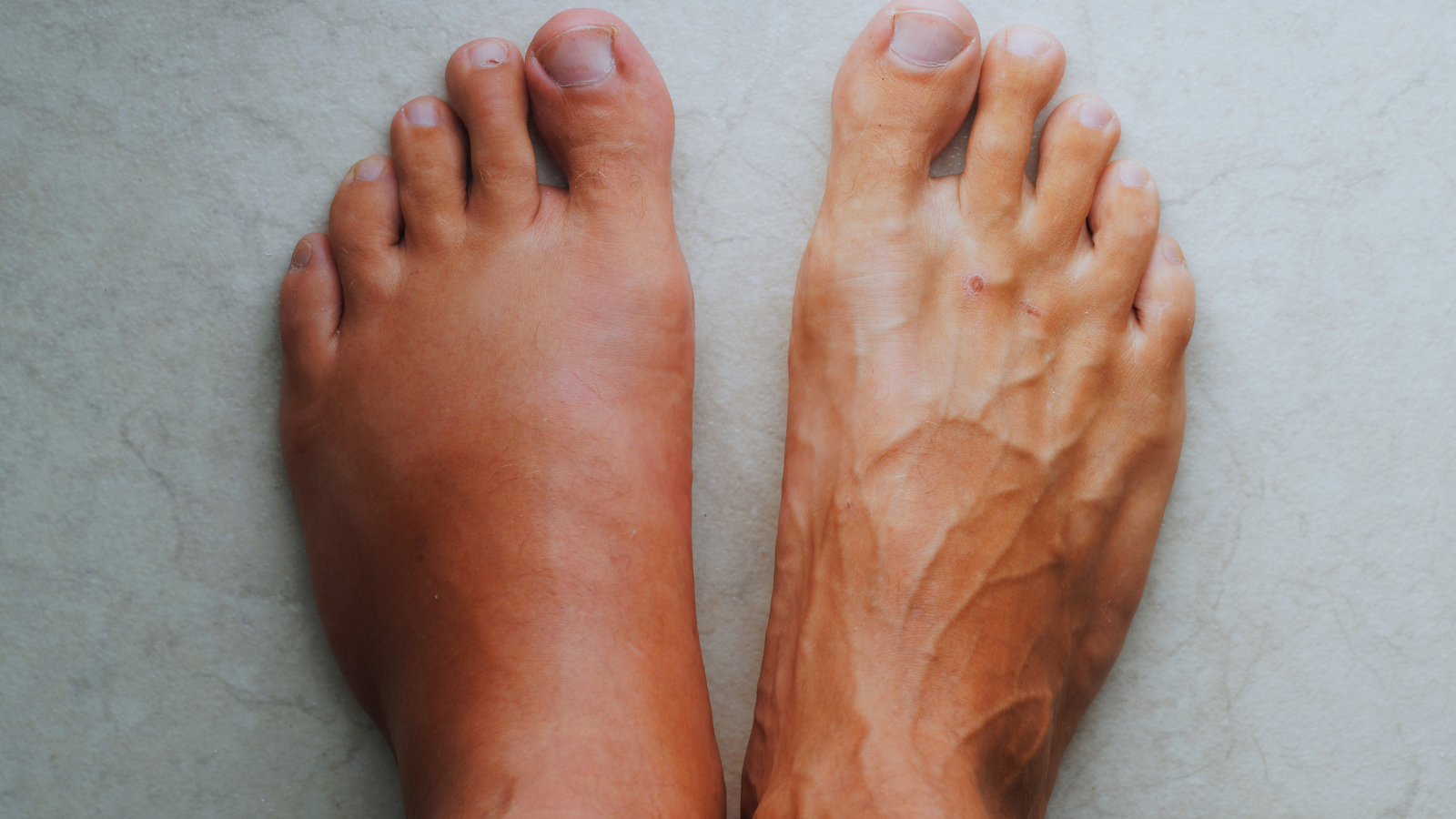 30 CRPS Mind-Body Recovery Statistics