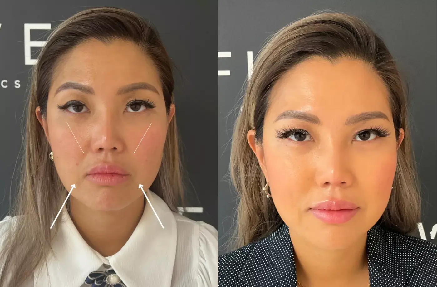 Mondhoeken en neuslippenplooi filler voor en na foto