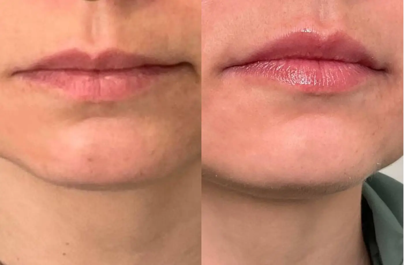 Botox lips before and after at Aēstec in Amsterdam